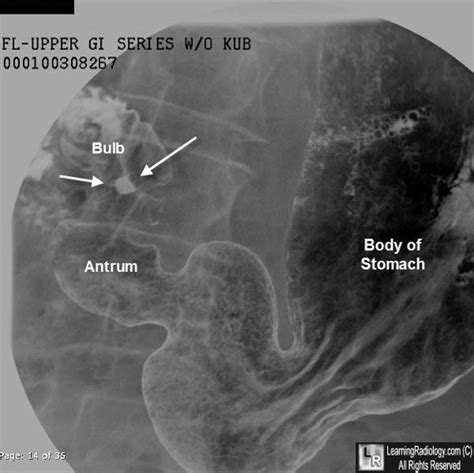 Learningradiology Duodenal Ulcer