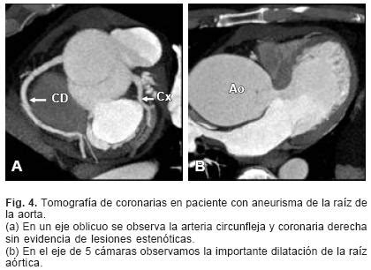 Tomograf A Computada Multidetector De Arterias Coronarias Estado Del