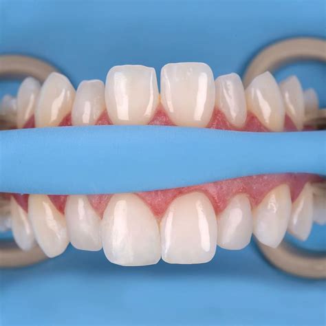 Composite Gc Injection Veneers Medimatch Dental Laboratory