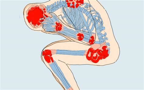 Fibromyalgie Symptome Behandlung Prognose