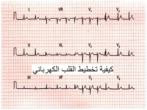 كيفية تخطيط القلب الكهربائي توعرب