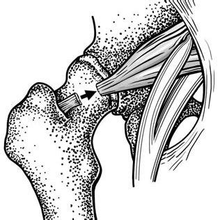 Pdf Sciatic Nerve Palsy After Total Hip Replacement