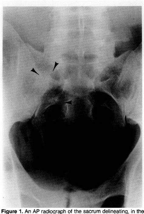 Figure 1 From Stress Fracture Of The Sacrum Semantic Scholar