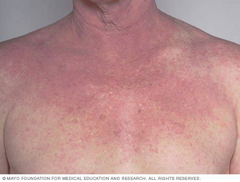 Atopic dermatitis (eczema) Disease Reference Guide - Drugs.com