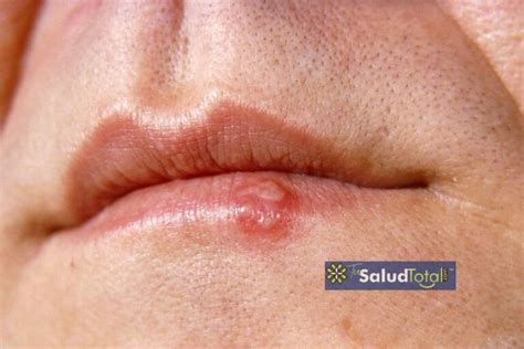 Síntomas y Causas del Herpes Labial 7 Desencadenantes