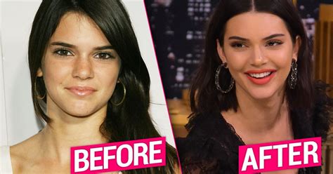 Kendall Jenner's Plastic Surgery Exposed By Top Docs