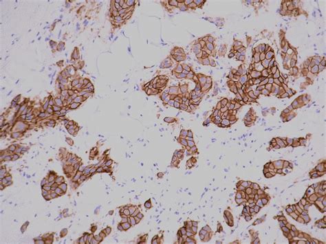 Pathology Outlines Her C Erbb Breast