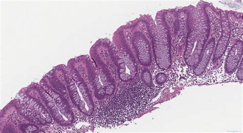 Tubular adenoma of the colon | Atlas of Pathology