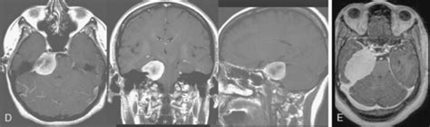 Overview Of Petroclival Meningiomas Clinical Gate