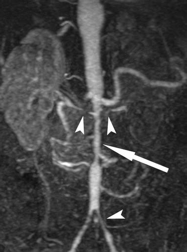 Takayasu Arteritis Radiology