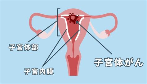 【医師監修】子宮体がんの予防と治療に水素吸入療法が役立つ？最新の研究結果を解説