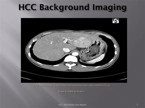 Hepatocellular Carcinoma Ppt Download