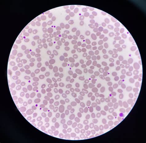 Abnormal Cell Macro Ovalocyte Stock Photo Image Of Care Capillary