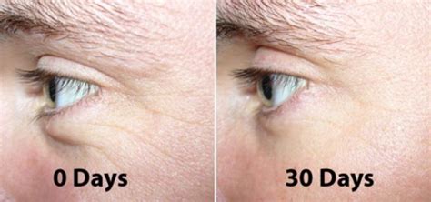 Argireline Before And After From Maker Antiagingtips In 2020 Wrinkle Cream Homemade Wrinkle