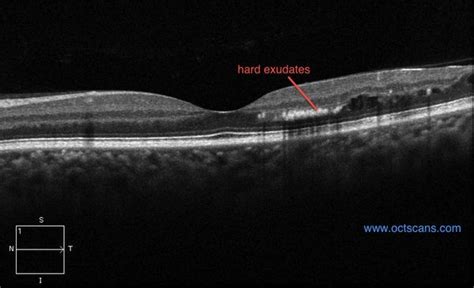 Exudates - Optical Coherence Tomography Scans