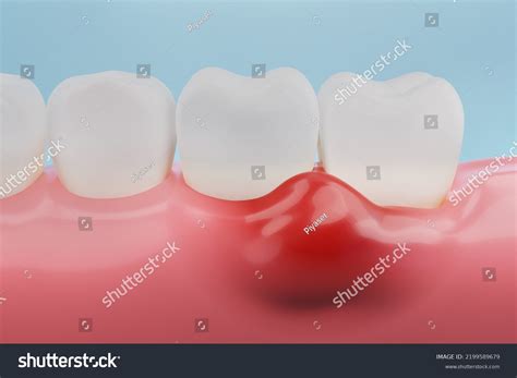 Periodontology 802 Images Photos Et Images Vectorielles De Stock