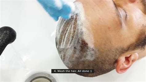 How To Wash Your Hair After Hair Transplant Antalya DK Klinik