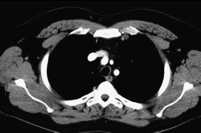 1.2 cm left internal mammary lymph node; unchanged on post chemotherapy ...