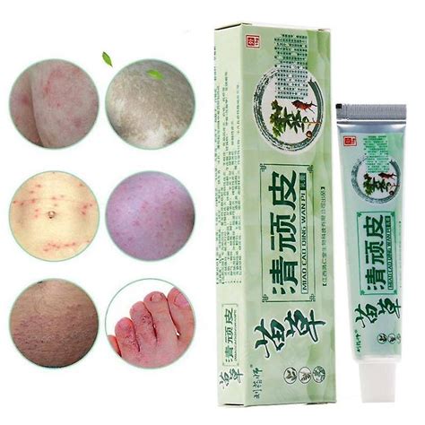 Herbal Skin Psoriasis Cream Eczema Psoriasis Treatment Antibacterial