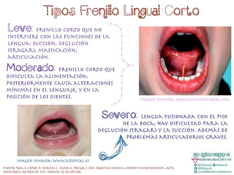 El Frenillo Lingual Corto Y Sus Repercusiones Espaciologopedico