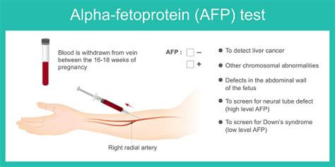 Alphafetoprotein Afp Test Use Analysis By Afp Level To Detect Liver ...