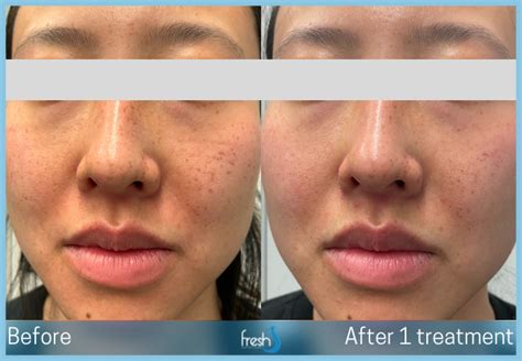 Pico Focus Pro Nw Calgary Fresh Laser Skin Studio