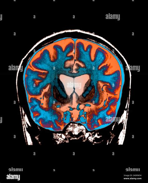 Brain in Huntington's disease. FLAIR magnetic resonance imaging (MRI ...