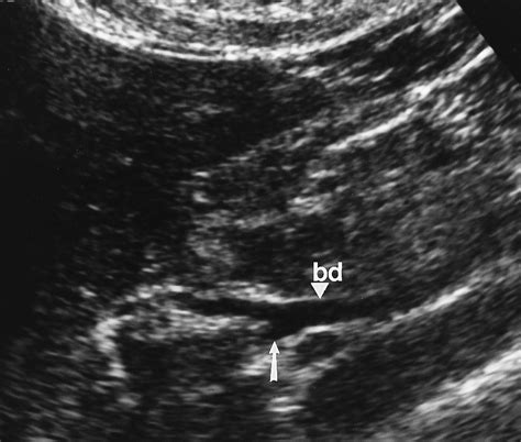 Cystic Duct Ultrasound