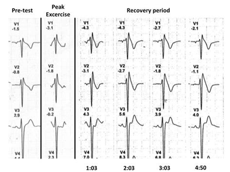 Electrocardiographic Leads V V And V During Exercise Testing At