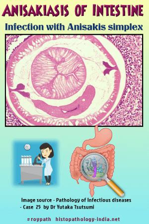 Pathology of Anisakiasis - Dr Sampurna Roy MD