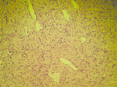 Histopathology Showing Interlacing Bundles Of Elongated Spindle Shaped