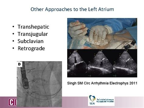 How To Perform A Successful Transseptal Puncture Zoltan