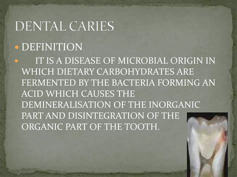 Microbiology Of Dental Caries Ppt