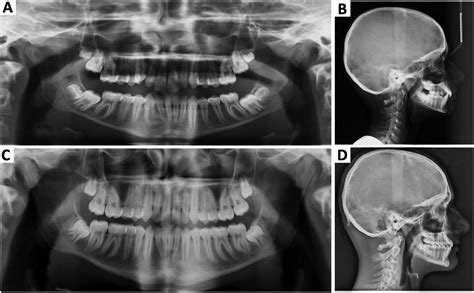 Clear Aligner Mandibular Advancement In Growing Patients With Class Ii Malocclusion Ajo Do