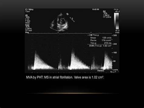 Mitral stenosis - Echocardiography