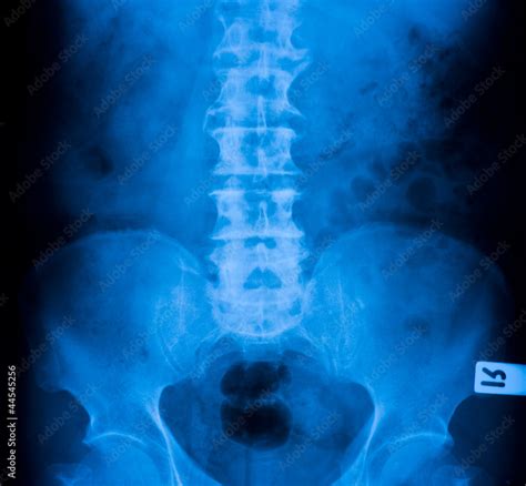 X-ray film of the pelvis Stock Photo | Adobe Stock