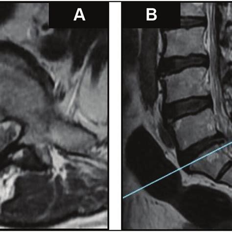 Illustrative case 2. (A) Preoperative MRI images of L5-S1 left-sided ...