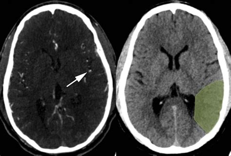 Ct For Treatment Selection In Acute Ischemic Stroke A Code Stroke