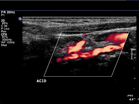 Residual flow of the internal carotid artery (ICA), as characterized by... | Download Scientific ...