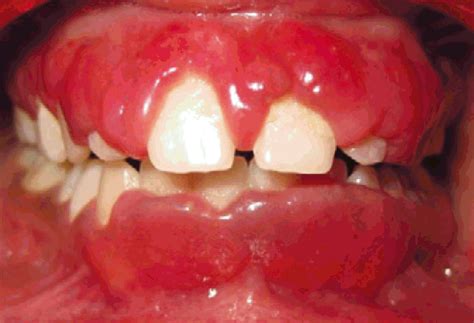 Plasma Cell Gingivitis Exodontia