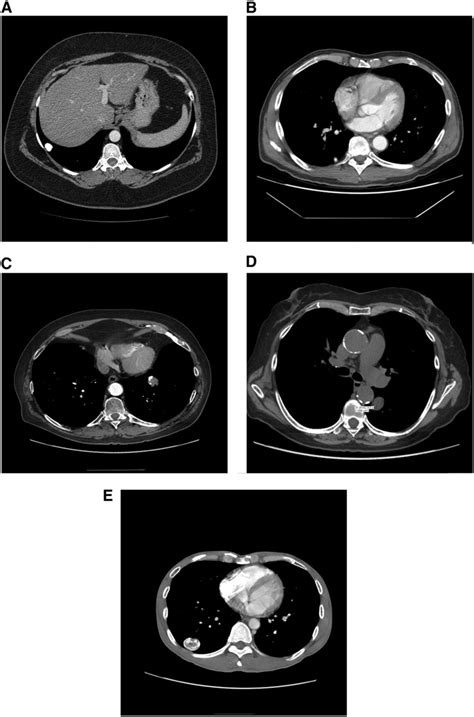 (A) Diffuse calcified granuloma. (B) Granuloma with central... | Download Scientific Diagram