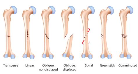 common fractures conditions orthosport victoria
