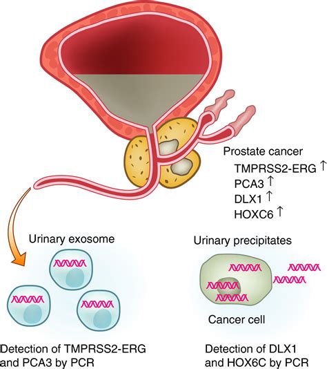 Urinary Biomarkers Of Prostate Cancer Fujita 2018 International