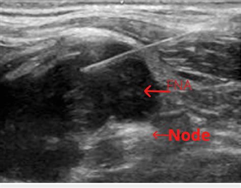 Ultrasound Guided Fine Needle Aspiration Of The Left Supraclavicular