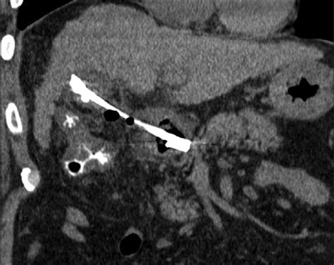 feasibility  conversion  percutaneous cholecystostomy  internal