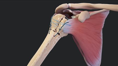 Arthrex FxBridge Tuberosity Repair System Reverse Total Shoulder