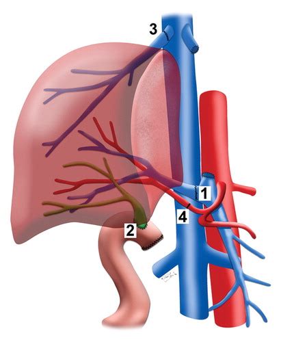 Postoperative Imaging In Liver Transplantation What Radiologists Should Know Radiographics