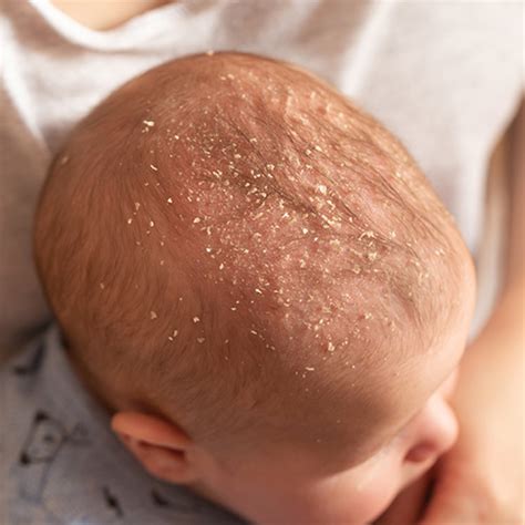 Natural And Safe Cradle Cap Solutions For Baby Jolimoli