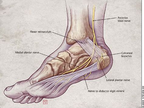 Tarsal Tunnel Syndrome