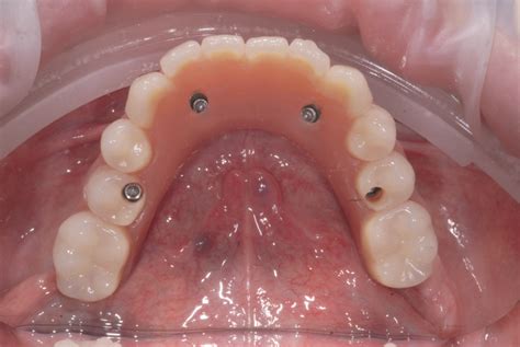 Riabilitazione Implantare Full Arch Computer Guidata Con Due Dime